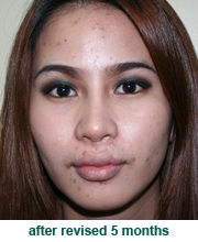 plastic_surgery_augmentation_rhinoplasty